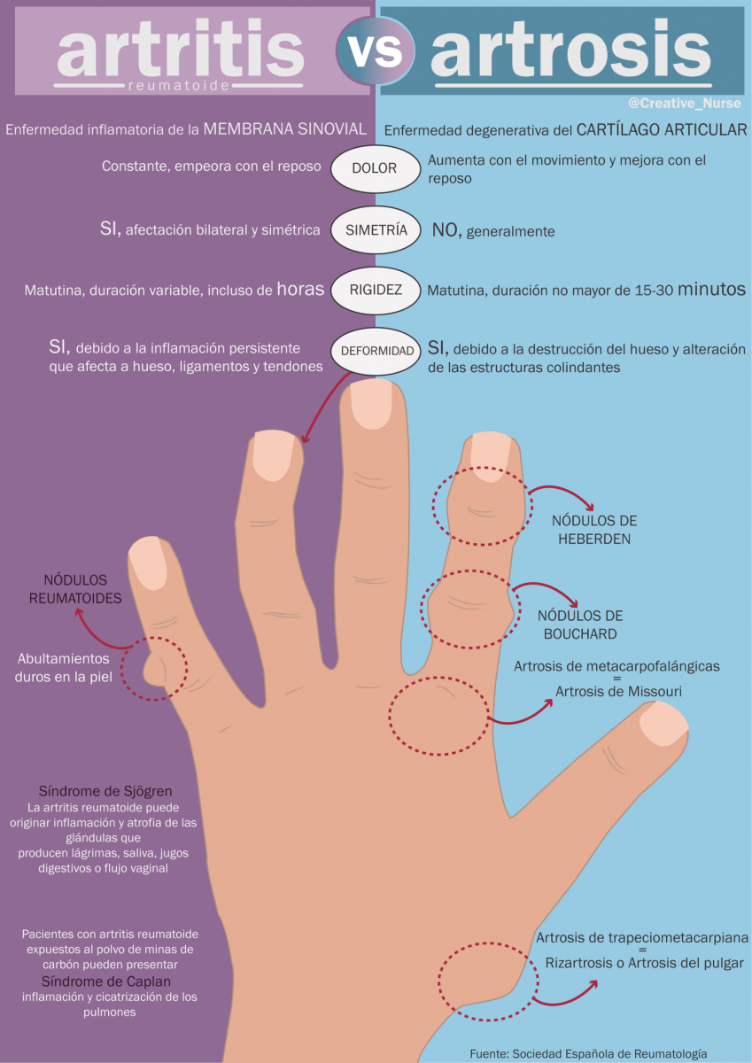 Reconozca el tipo de dolor en manos que indica si padece de artrosis  nodular, artritis o