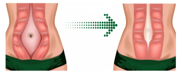 Diástasis abdominal
Entrenamiento
Posparto