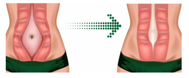 Diástasis abdominal
Entrenamiento
Posparto Diástasis abdominal
Entrenamiento
Posparto